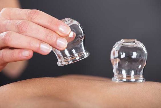 Therapist Giving Cupping Treatment On Back